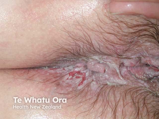 Vulval and perianal erosions due to paraneoplastic pemphigus