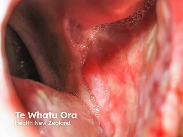 Buccal erosions due to paraneoplastic pemphigus, there was an underlying follicular lymphoma