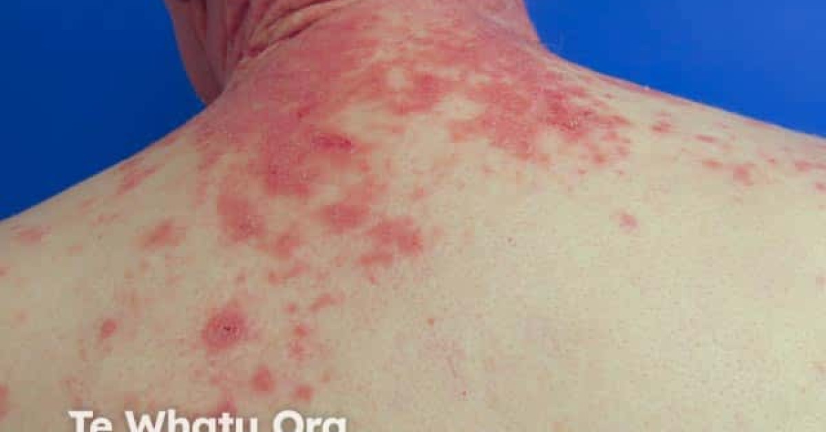 Paraneoplastic pemphigus image