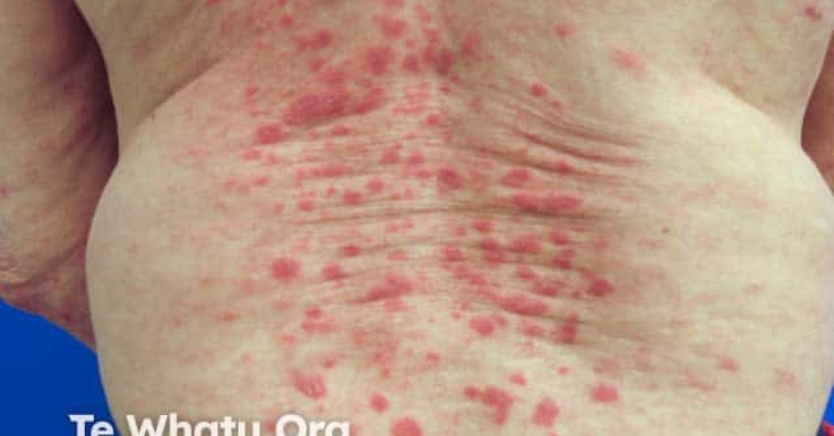 Paraneoplastic Leg Rash Paraneoplastic pemphigus image