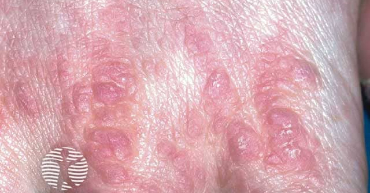 Paraneoplastic Leg Rash Paraneoplastic pemphigus image