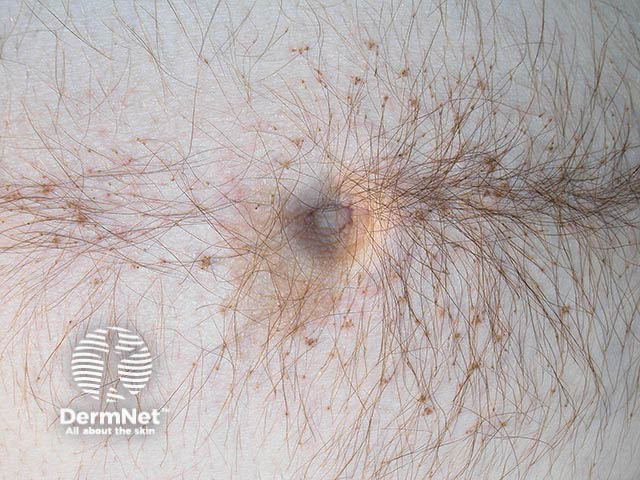 Pubic lice evident in the umbilical area