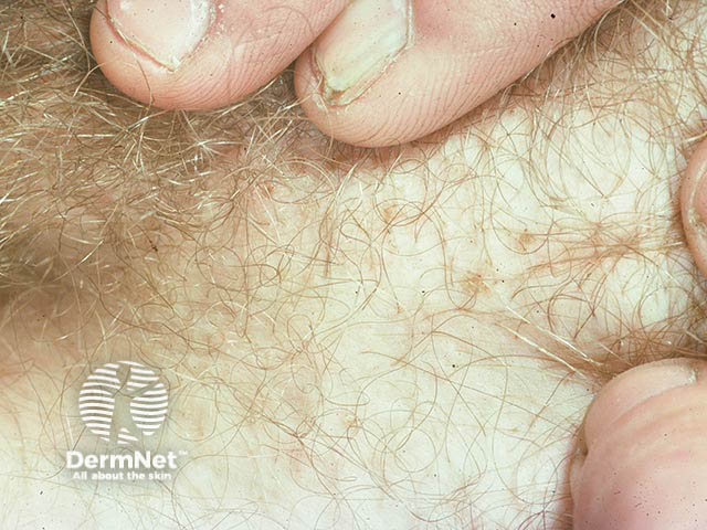 Pubic lice adjacent to the skin and adherent to the pubic hair