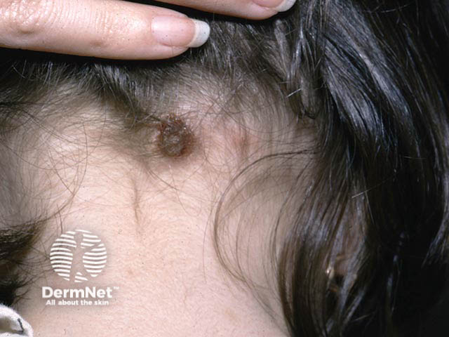 Scalp pyoderma due to pediculosis