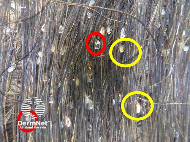 Dermoscopic image of female child with pediculosis showing dark brown viable nits attached to the shaft (yellow circles) and translucent hatched nits (red circles)