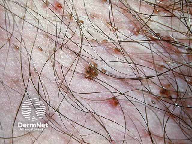 Egg cases adherent to the pubic hair are more conspicuous than the adult lice - a dermatoscope can help readily visualise both