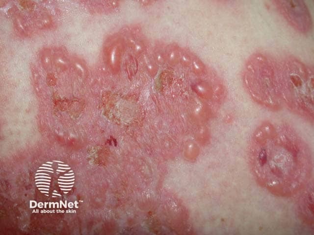 Pemphigoid gestationis