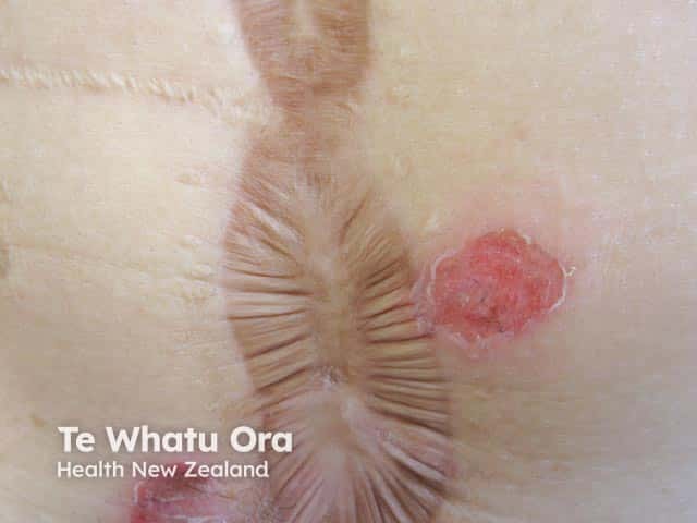 Pemphigoid gestationis and hyperpigmented scar
