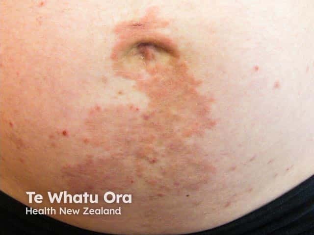 Pemphigoid gestationis: pregnant abdomen