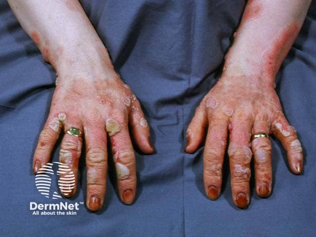 Pemphigoid gestationis: hands