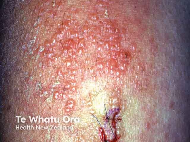Pemphigoid gestationis