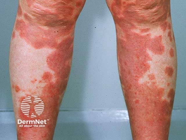 Pemphigoid gestationis: legs