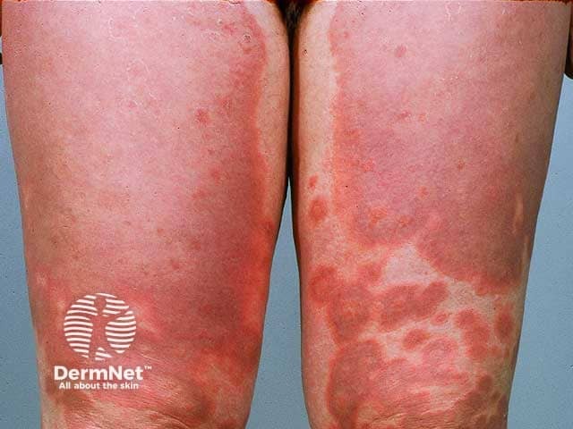 Pemphigoid gestationis: thighs