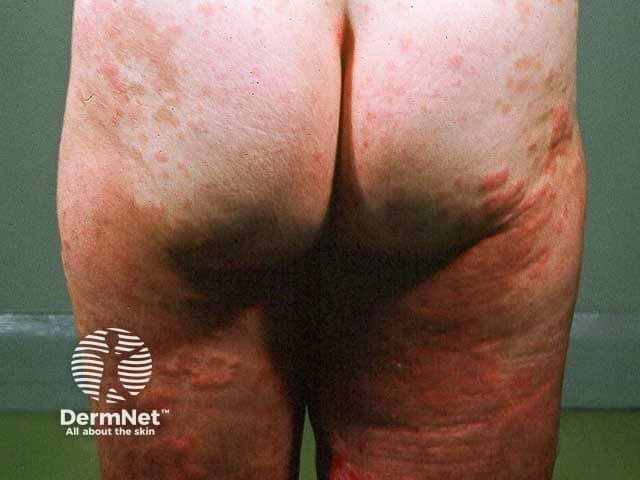 Pemphigoid gestationis: buttocks