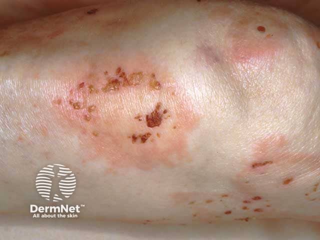 Clustered crusts and blisters in a herpetiform distribution in pemphigus herpetiformis, secondary to penicillamine