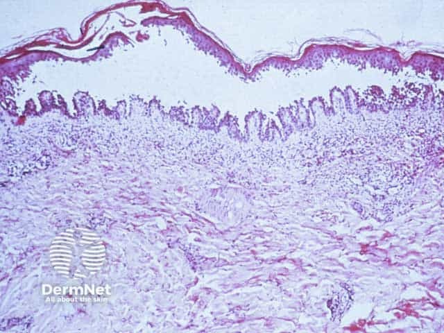 Suprabasal intraepidermal blister formation with acantholytic keratinocytes and 