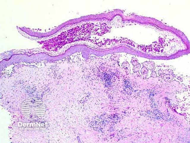 Suprabasal intraepidermal blister formation with acantholytic keratinocytes and "tomb stone" basal keratinocytes in pemphigus vulgaris