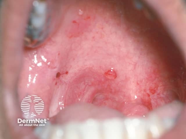 An intact blister on the palate in pemphigus vulgaris