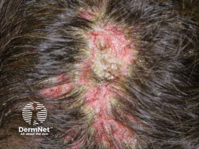 Scalp macceration and crusting in pemphigus vulgaris