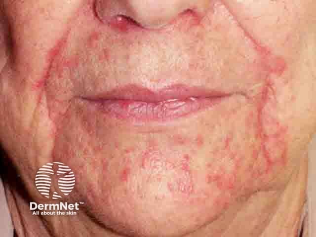 Perioral erythematous papules sparing the immediate perivermillion skin in perioral dermatitis