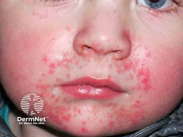 Perioral dermatitis due to the use of a steroid nebuliser mask