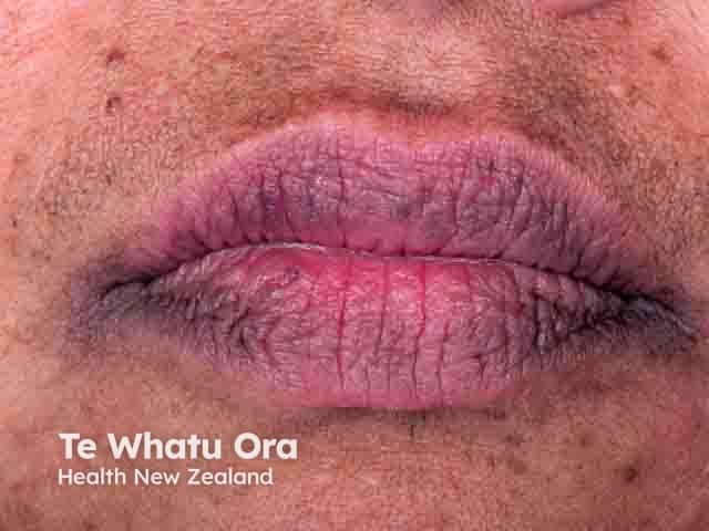 Perioral papules due to perioral dermatitis in skin of colour