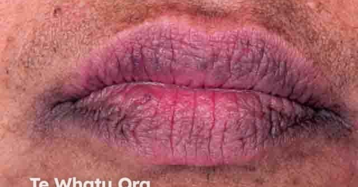 DermNet® - Perioral dermatitis image