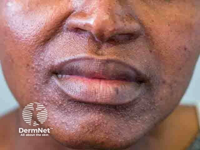 Perioral dermatitis in a woman of African descent