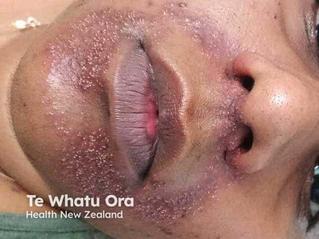 Papules and pustules (an unusual feature) in perioral dermatitis