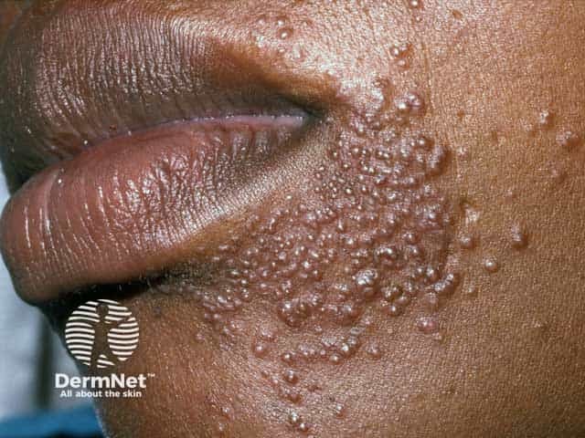 Florid perioral dermatitis due to potent topical steroid use