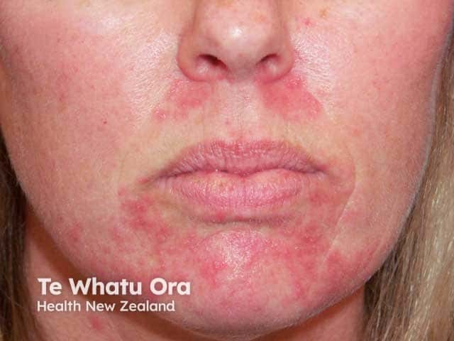 Perioral and nasolabial fold papules sparing the perivermillion skin in perioral dermatitis