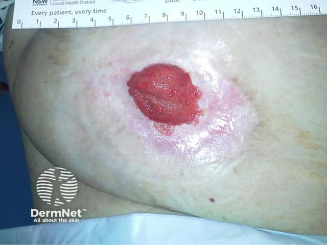 Re-epithelialised granular eruption which was emanating from ileostomy site 
