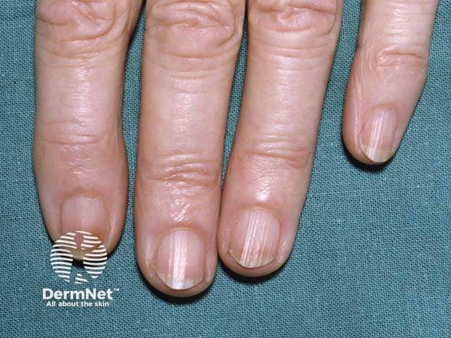 Nail pigmentation due to hydroquinone