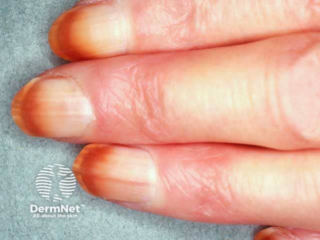 Nail pigmentation due to hydroquinone