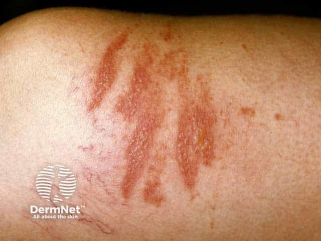 Streaked lesions in phytophotodermatitis