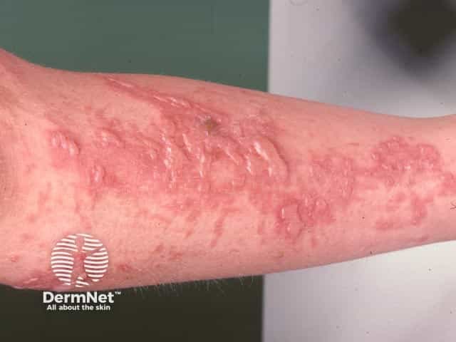 Phytophotodermatitis from hogweed