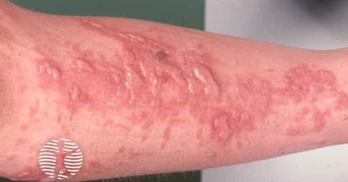 Phytophotodermatitis image