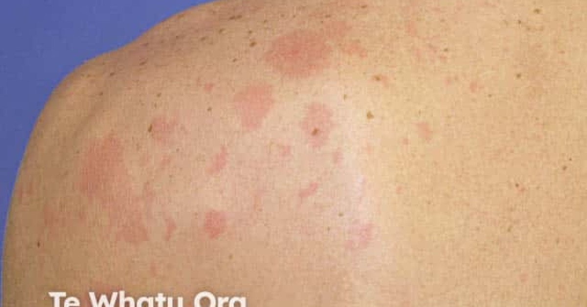 Phytophotodermatitis image