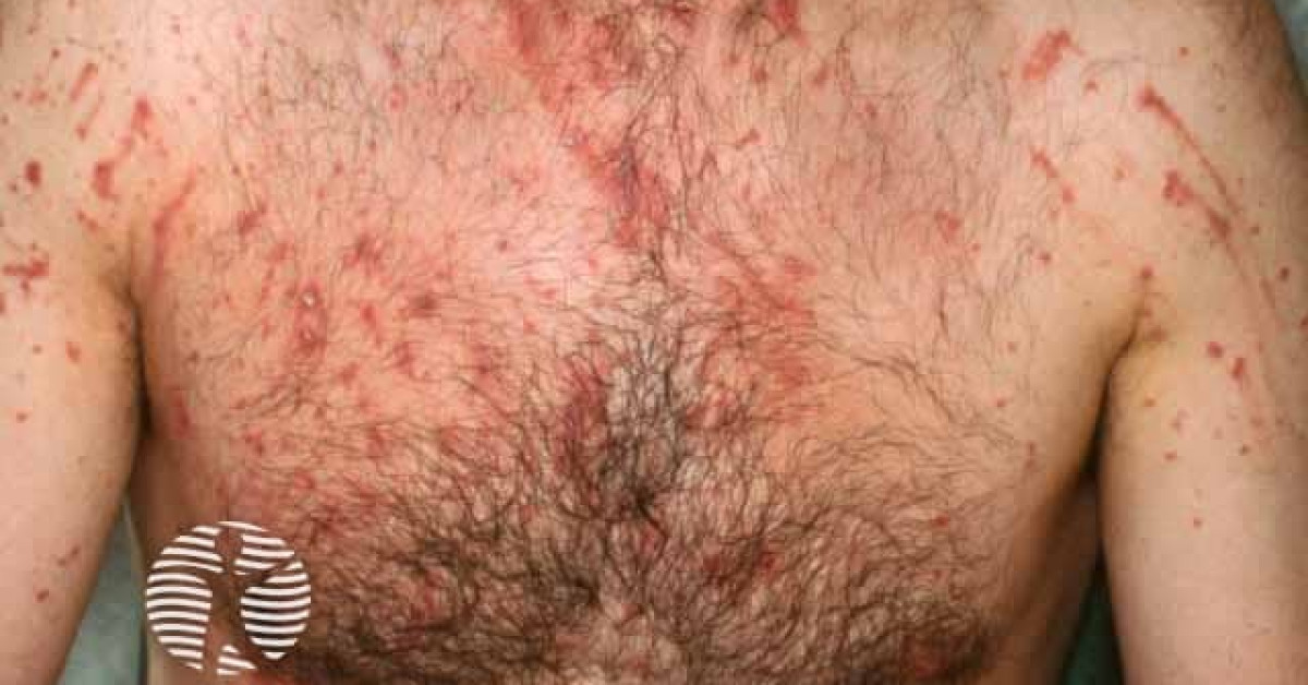 Phytophotodermatitis image