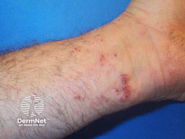 Healed phytophotdermatitis blisters on the wrist