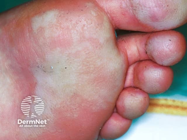 White macerated and pitting plantar skin in pitted keratolysis