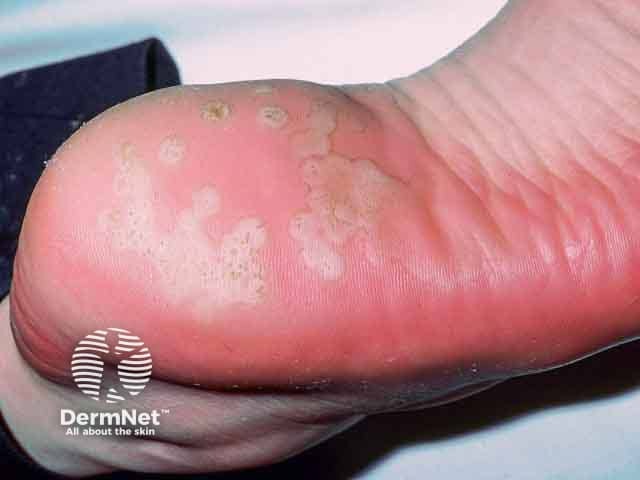 White pitted macerated skin on the heels due to pitted keratolysis