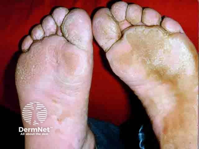 Pits over the toes, forefoot and soles in pitted keratolysis