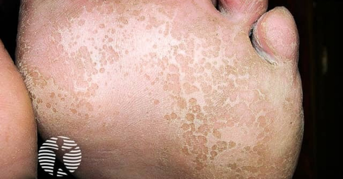 Pitted keratolysis image