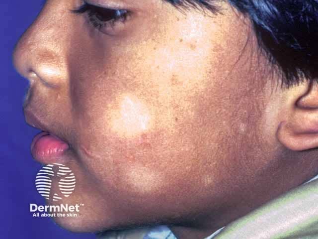 Hypopigmentation and fine scale on the cheeks in pityriasis alba