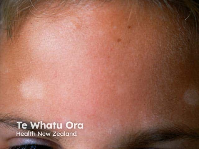 Pityriasis alba on the forehead