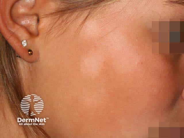 Mild scale and hypopigmentation in pityriasis alba