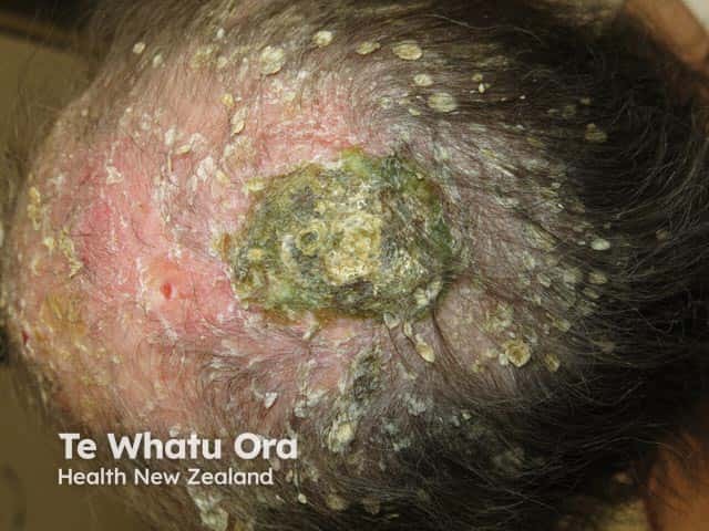 Severe scalp psoriasis resulting in massive adherant scale and pityriasis amiantacea