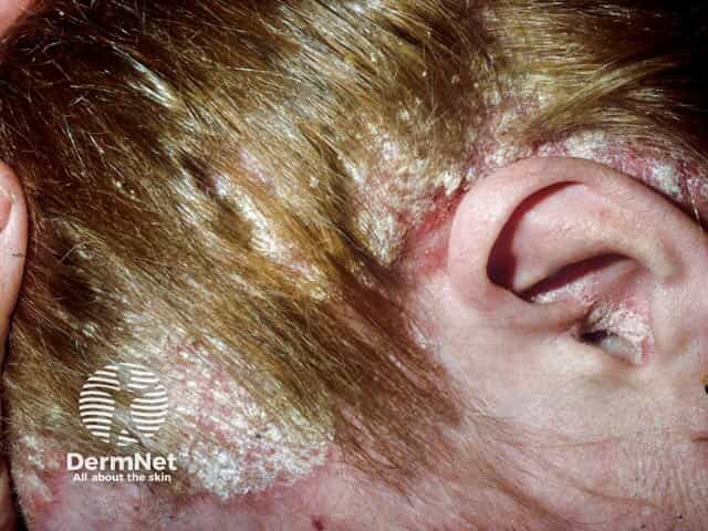 Severe scalp psoriasis with areas of pityriasis amianticea