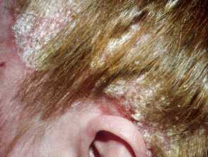 Scalp Psoriasis: A Complete Overview — DermNet
